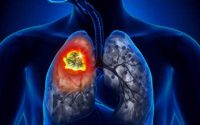 Fibroza pulmonară: Cauze, simptome, tratament și prognostic