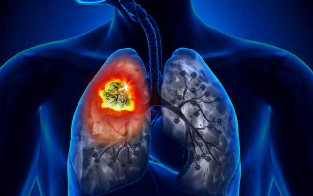 Fibroza pulmonară: Cauze, simptome, tratament și prognostic