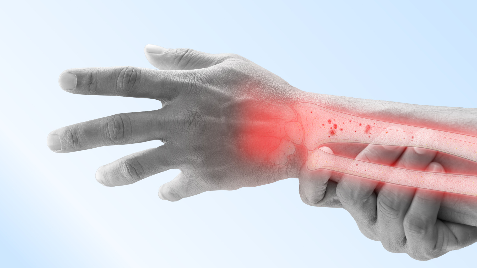 osteoporoza